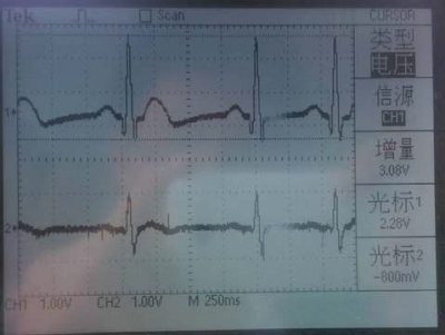 electrocardiosignal record and playback